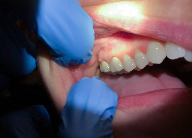 Best Emergency Dentist for Lost Fillings or Crowns in Mledgevle, IL
